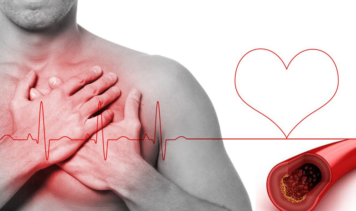 Doença arterial coronariana é a principal causa de morte súbita em atletas com mais de 35 anos