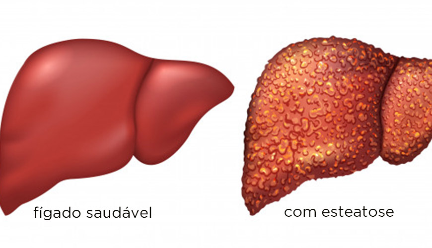 Por que os portadores de esteatose hepática têm maior risco cardiovascular?